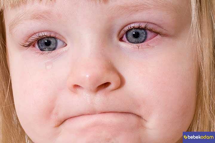 Çocuklarda Göz Nezlesi: Ne İyi Gelir?